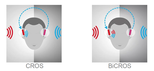 Schéma appareillage auditif CROS et BICROS